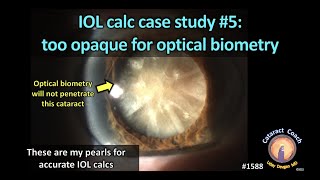 CataractCoach 1588: IOL calc case study 5: too opaque for optical