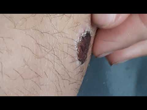 Scab peeling (part 1)