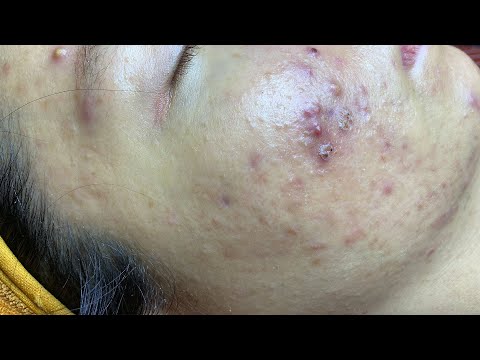 Video Acne Hidden Under Skin And Acne Hematoma |Mụn Ẩn, Mụn... - youtube