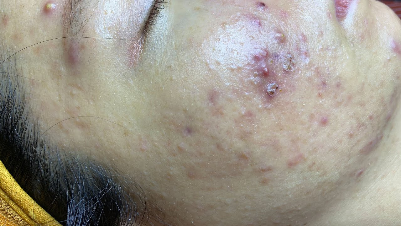 Acne Hidden Under Skin And Acne Hematoma |Mụn Ẩn, Mụn Viêm Tụ Máu Trên Da  - SacDepSpa#213