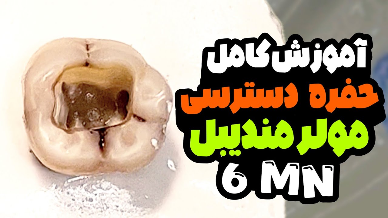 access cavity of lower 6 step by step/تهیه حفره دسترسی مولر پایین