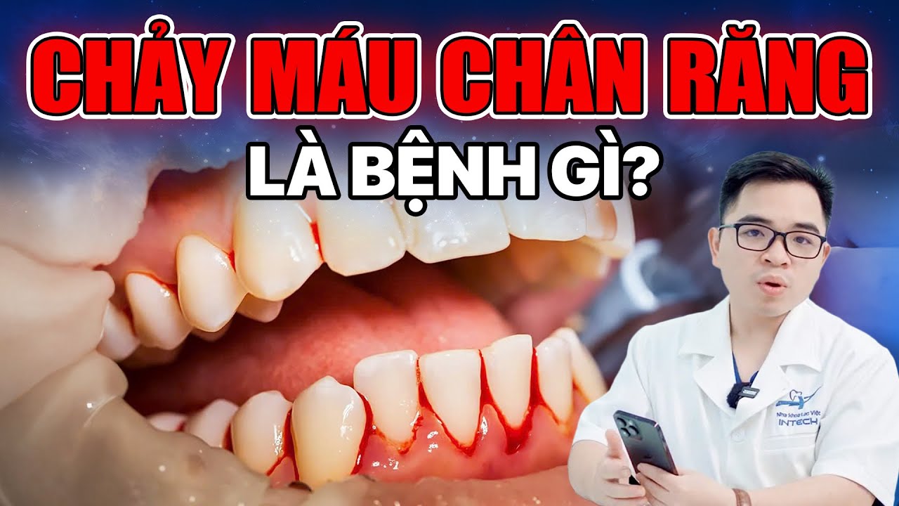 Outline Video Chảy Máu Chân Răng: 5 Cách Ngừng Chảy Máu Chân Răng Ngay Lập Tức!