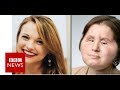 Coping with our daughter's new face - BBC News