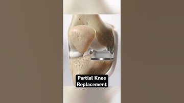 Partial Knee Replacement (3D Animation)