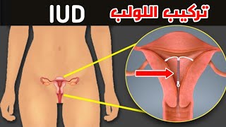 شاهد طريقة تركيب اللولب لمنع الحمل_وتعرف علي المميزات والعيوب_ Birth control device (IUD)
