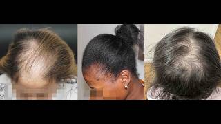 Hair Loss in Women