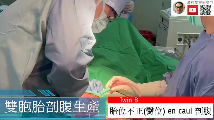 雙胞胎剖腹生產 + 胎位不正 en caul 生產 C/S for twin + en caul [血腥版，收看需慎重] - 天天要聞