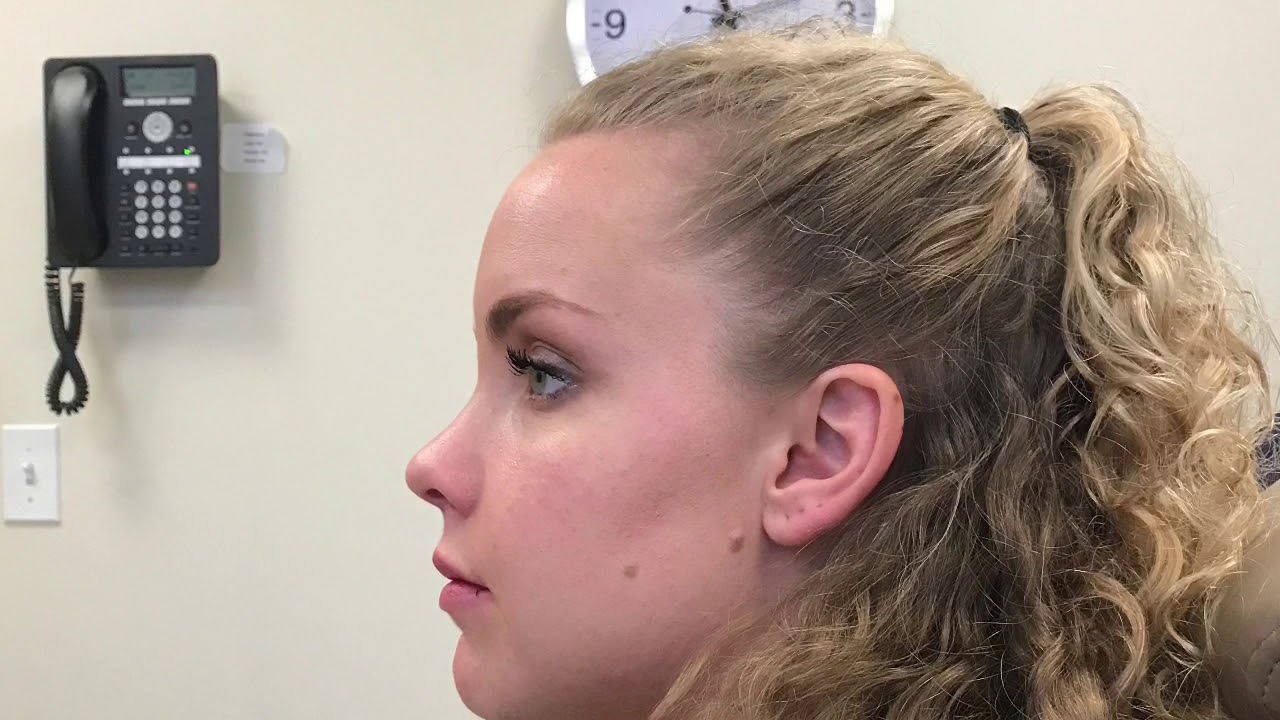 Double Jaw Surgery Recovery Before And After YouTube