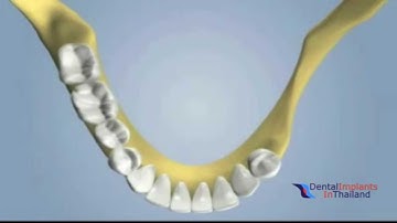 Dental Grafting Block Autografting Using Localized Ridge Augmentation @ Dental Center of Thailand