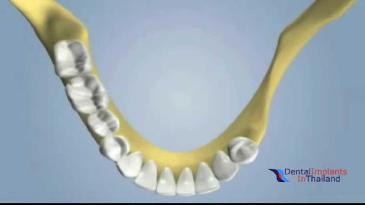 Dental Grafting Block Autografting Using Localized Ridge Augmentation