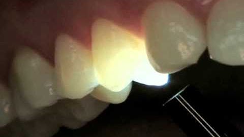 Endodontics Torabinejad 5-13 Transillumination