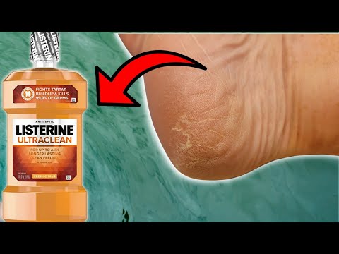 💦Soak your feet with Mouthwash and 💥WATCH WHAT HAPPENS