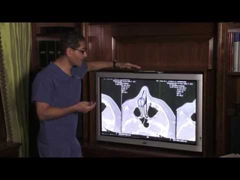 Video thumbnail: Dr. Sam Rizk Repairs Deviated Septum, Crooked Nose & Nasal Fracture, Part 2