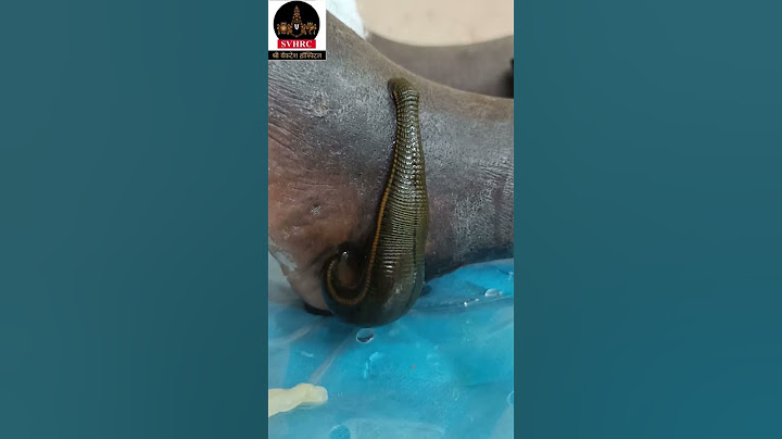 Leech Therapy for remove bad blood #shorts #youtubeshorts #shortsfeed #trending #viral #love #life