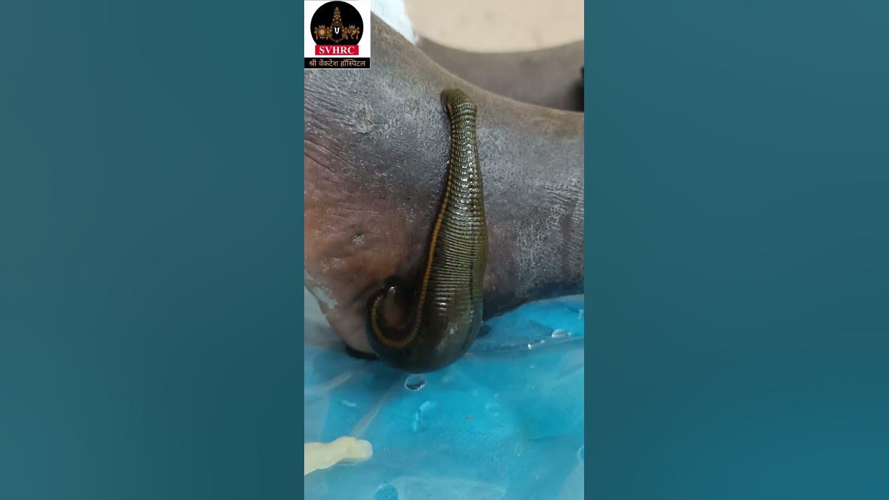 Leech Therapy for remove bad blood #shorts #youtubeshorts #shortsfeed #trending #viral #love #life