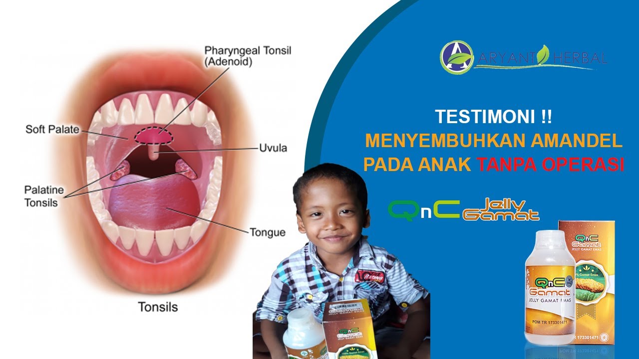Cara Alami Mengobati Penyakit Amandel Tanpa Operasi || Testimoni QnC