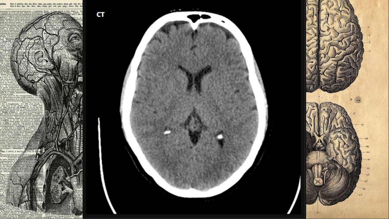 🏅TOMOGRAFIA (TAC) de CRANEO 🩻- Ventana Cerebro, image size:1280x720