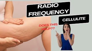 Where to Use Radio Frequency for Cellulite Reduction | SCULPTSKIN