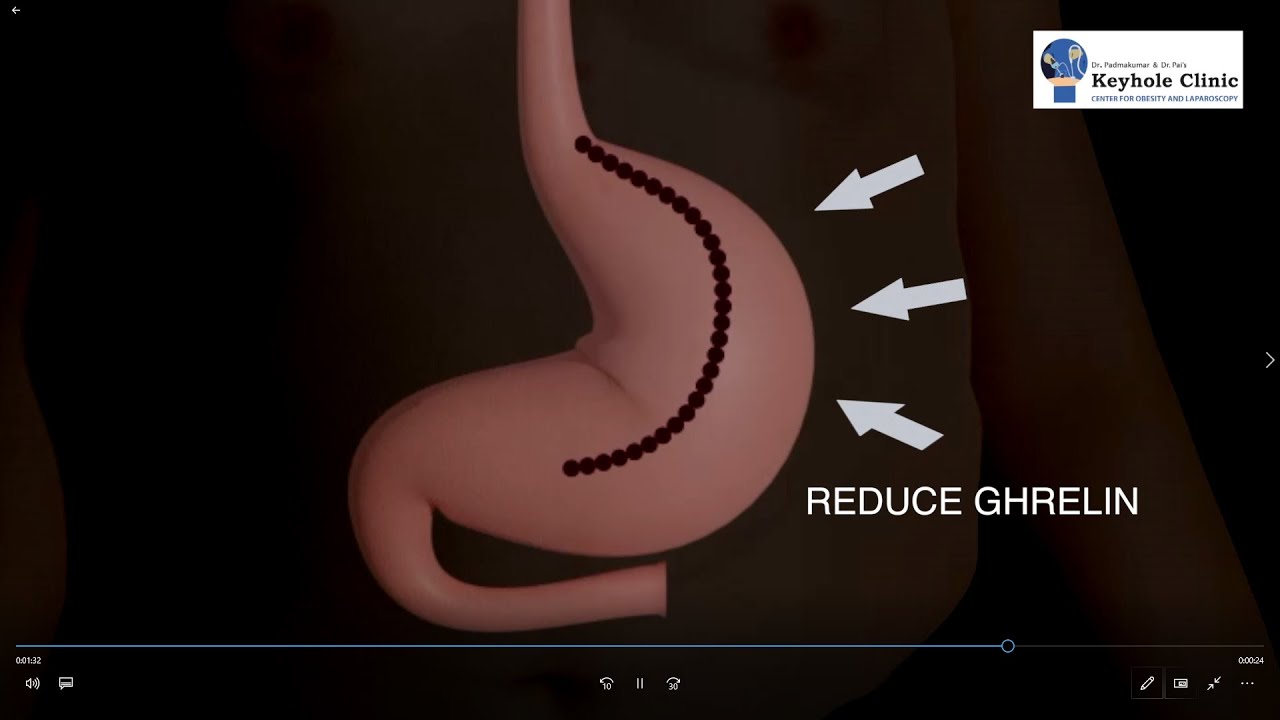 Laparoscopic Sleeve Gastrectomy Animation English YouTube