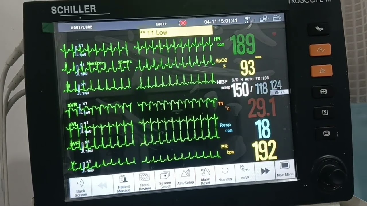 Supraventricular tachycardia treated with inj Dilzem 
