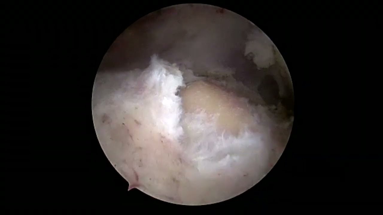 Arthroscopic Double-Row Rotator Cuff Repair Technique for Small Tears
