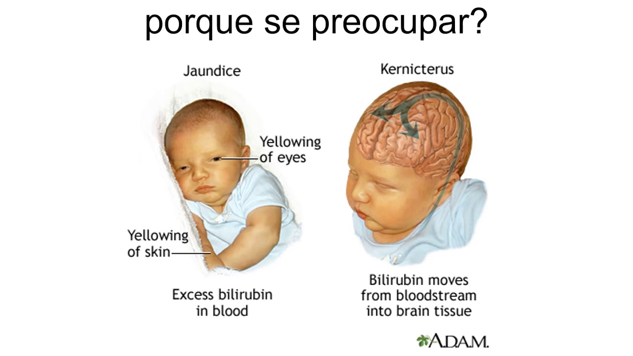 Физиологическая желтуха новорожденных. Причины развития желтухи у новорожденных. Физиологическая желтуха у новорожденных показатели билирубина. Норма уровня желтушки у новорожденных. Физиологическая желтуха новорожденных норма.