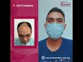 Jayrold&#39;s Hair Transplant Results after 2 Years (3,000 Grafts)