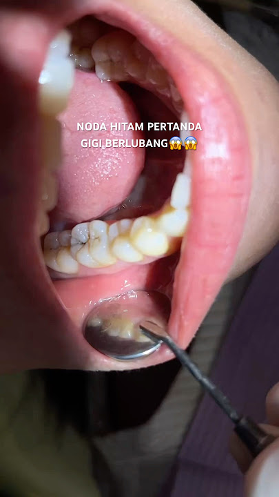 NODA HITAM TANDA GIGI BERLUBANG😱 #tambalgigi #gigiberlubang #getdentist #klinikgigi