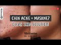 Maskne, is it just Chin Acne? | 8 Maskne Treating Skincare Products to Help You Get Clear Skin