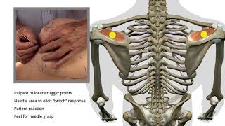 Trigger Point Release | Supraspinatus | Shoulder Pain | Wrist Pain | Dry Needling