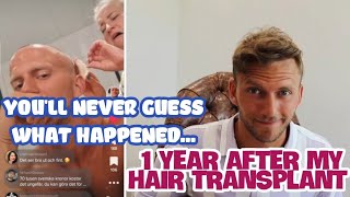 1 Year After My Hair Transplant - The WEIRDEST story...