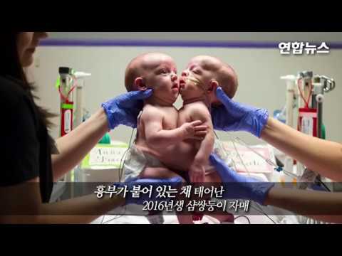 [현장영상] 흉부 붙은 채 태어난 샴쌍둥이 자매...