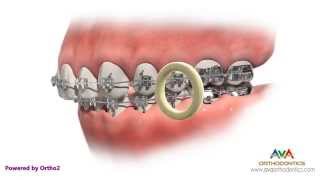 Types of Orthodontic Elastics And Why You Need to Wear Them