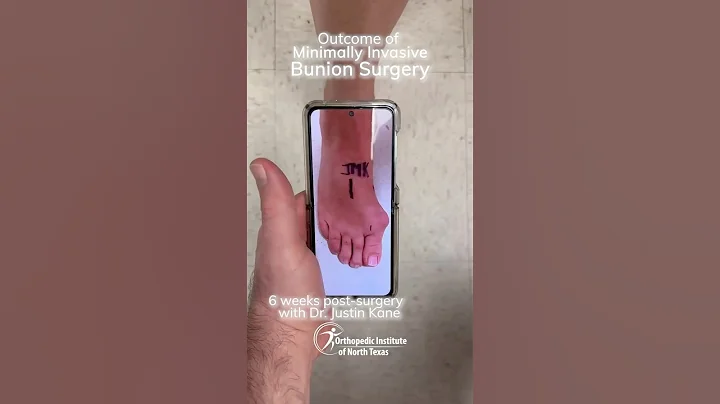 6 Weeks After Minimally Invasive Bunion Surgery. Fast Recovery with Dr. Kane at OINT