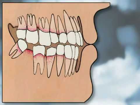 What are pros and cons of mini dental implants?