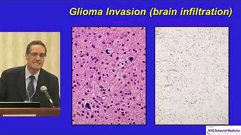 Dr. David Zagzag on Understanding Your Pathology Report