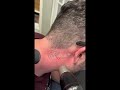 Laser tattoo removal on neck tattoo with Picosure