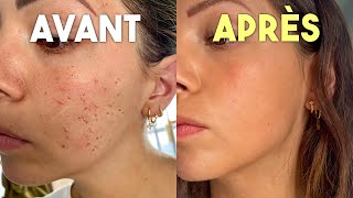 Comment Je Me Suis Débarrassée Des Microkystes