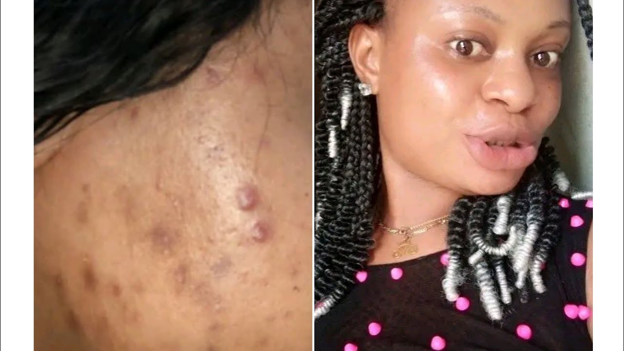 3days turmeric and tea tree oil face mask for stubborn acne and pimple