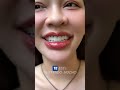 Blanquea tus dientes en minutos con esta receta casera (rápido y fácil)