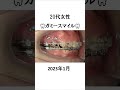 ガミースマイルの矯正治療 #矯正歯科 #歯医者 #美容
