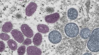 Children, pets included in monkeypox case count