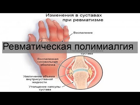 Ревматическая полимиалгия