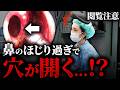 【閲覧注意】鼻のほじり過ぎで鼻中隔に穴が開いてしまった…【鼻中隔穿孔手術】