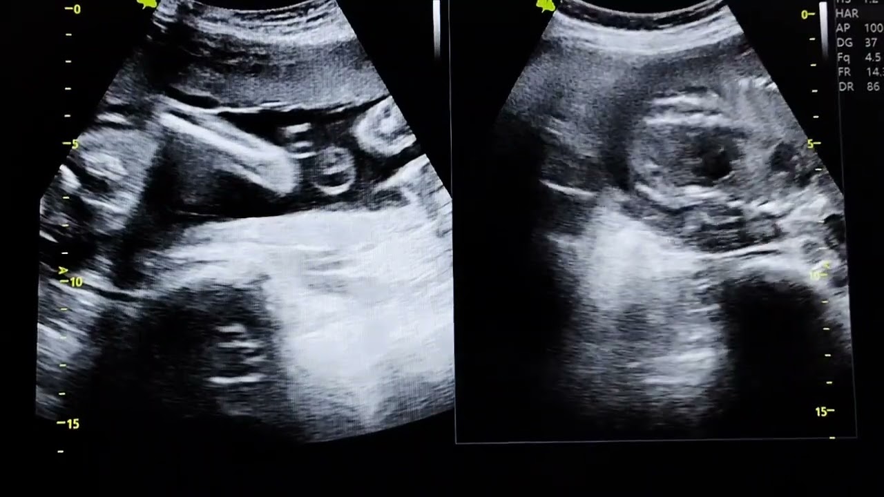 Ecografias De 24 Semanas De Embarazo ECOGRAFÍA DE 24 SEMANAS DE GESTACIÓN FEMENINO - YouTube