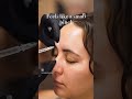 Botox Before and After in Houston | How Botox Works & What to Expect