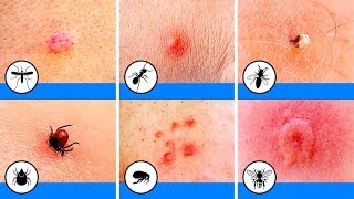 كل ما تحتاج لمعرفته عن رؤية الحشرات على جسمك - أسباب ظهور الحشرات على الجلد