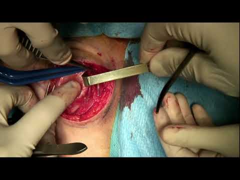 Quiste II Hendidura Branquial/Second Brachial Cleft Cyst