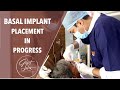 Dental Implant work in Progress | Fixed Artificial Teeth | Denture | Best Dental Clinic in India