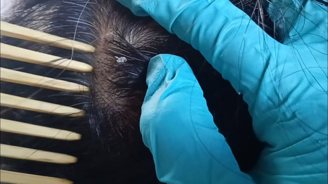 ASMR Scalp Check & Dandruff Removal